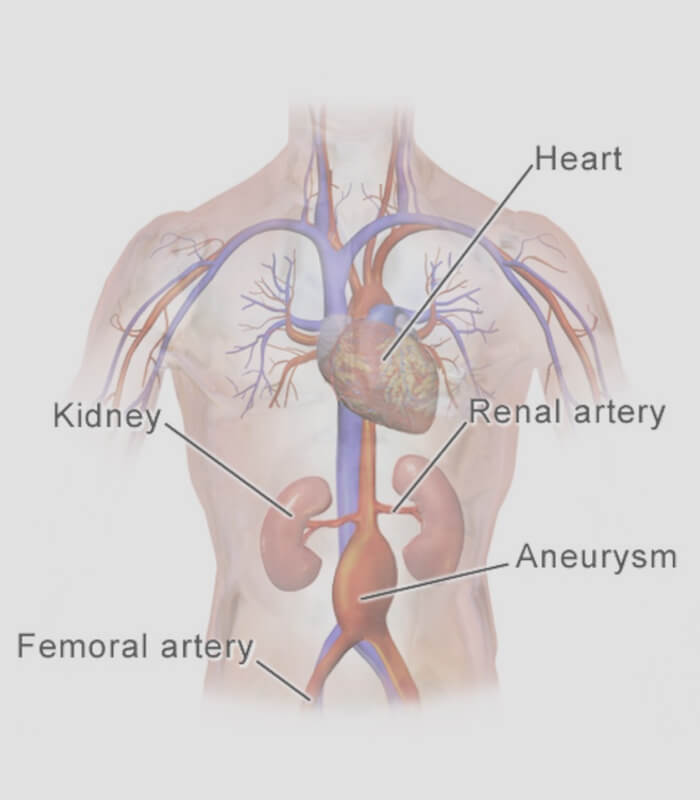 Abdominal Aortic Aneurysm