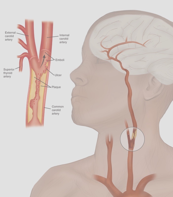 CAROTID ARTERY DISEASE TREATMENT IN SNELLVILLE