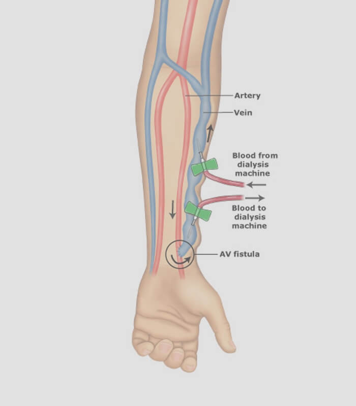 Dialysis Access Management Treatment