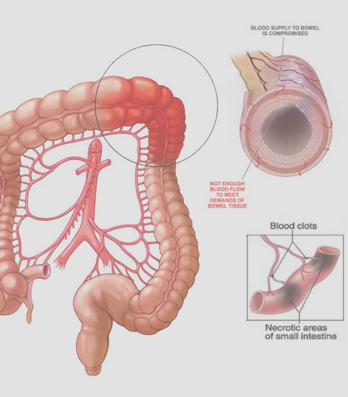 Mesenteric Artery Stenosis