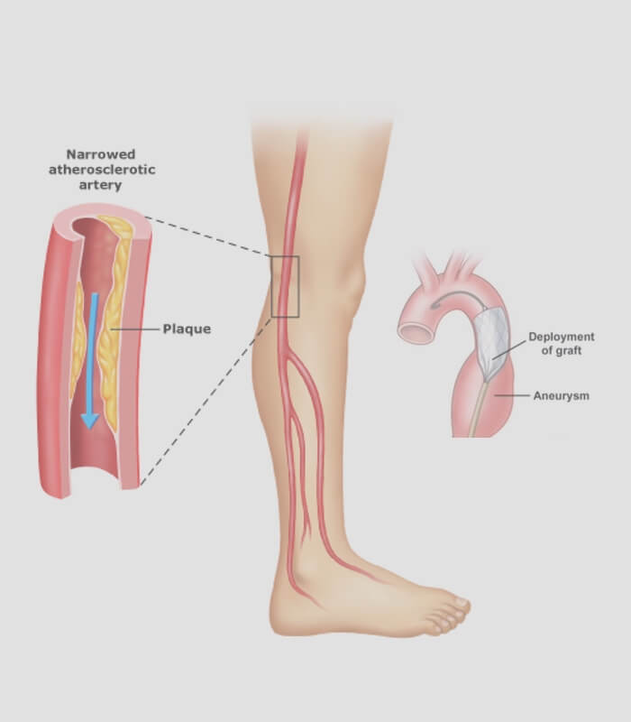Mesenteric Artery Stenosis