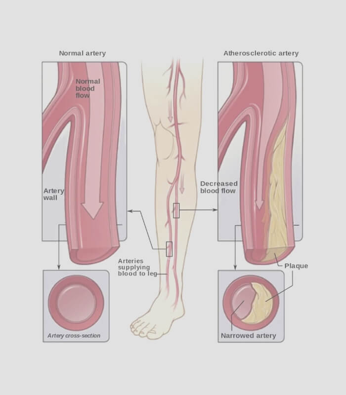 Leg Cramps/Peripheral Artery
