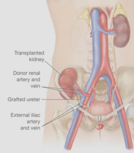 RENAL ARTERY STENOSIS TREATMENT IN LITHONIA
