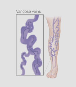 VERICOSE VEINS TREATMENT IN LITHONIA