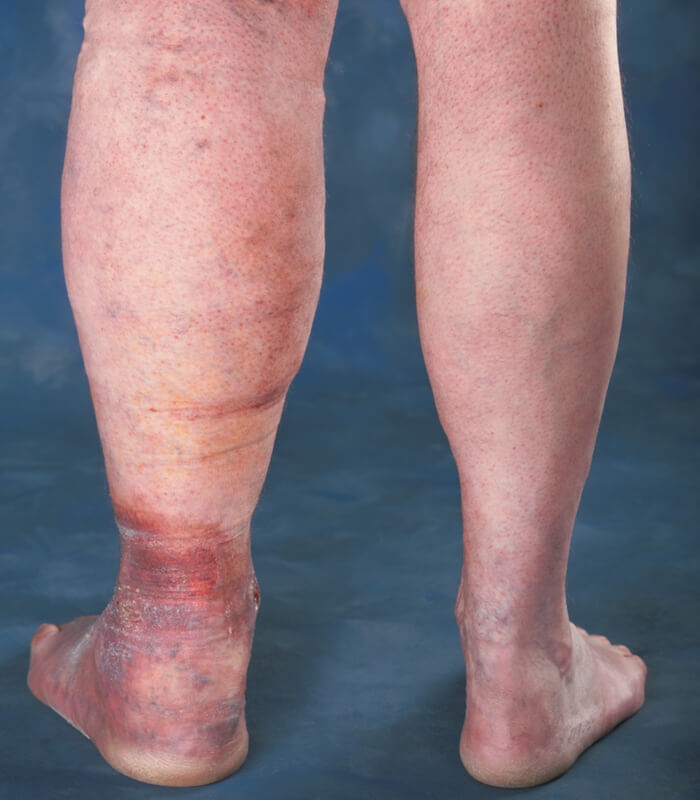 DVT (Deep Vein Thrombosis)