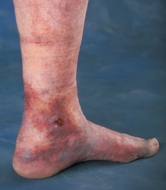 Venous Insufficiency