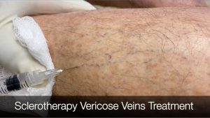 Sclerotherapy varicose veins Treatment