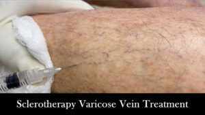 vein treatment video