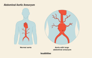 risk factors of aortic aneurysm