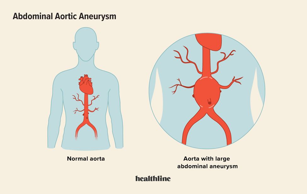 what-causes-aortic-aneurysms-milner-vein-vascular