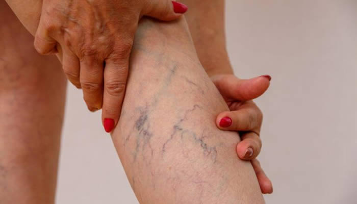 varicose veins dangers