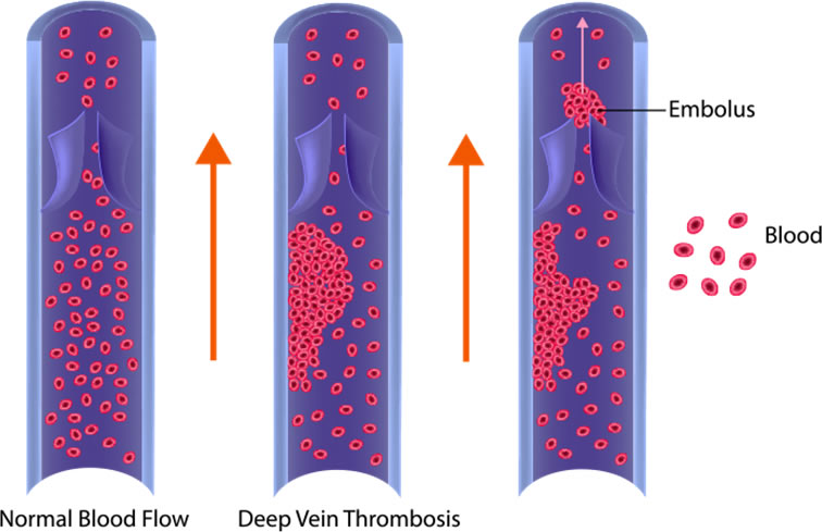 What Are The Symptoms of Deep Vein Thrombosis?