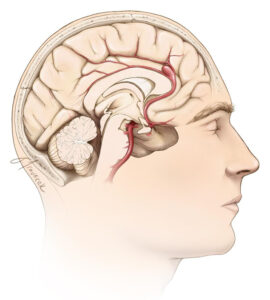 peripheral aneurysm
