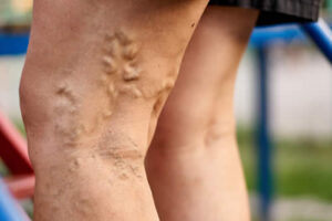 Spider Veins